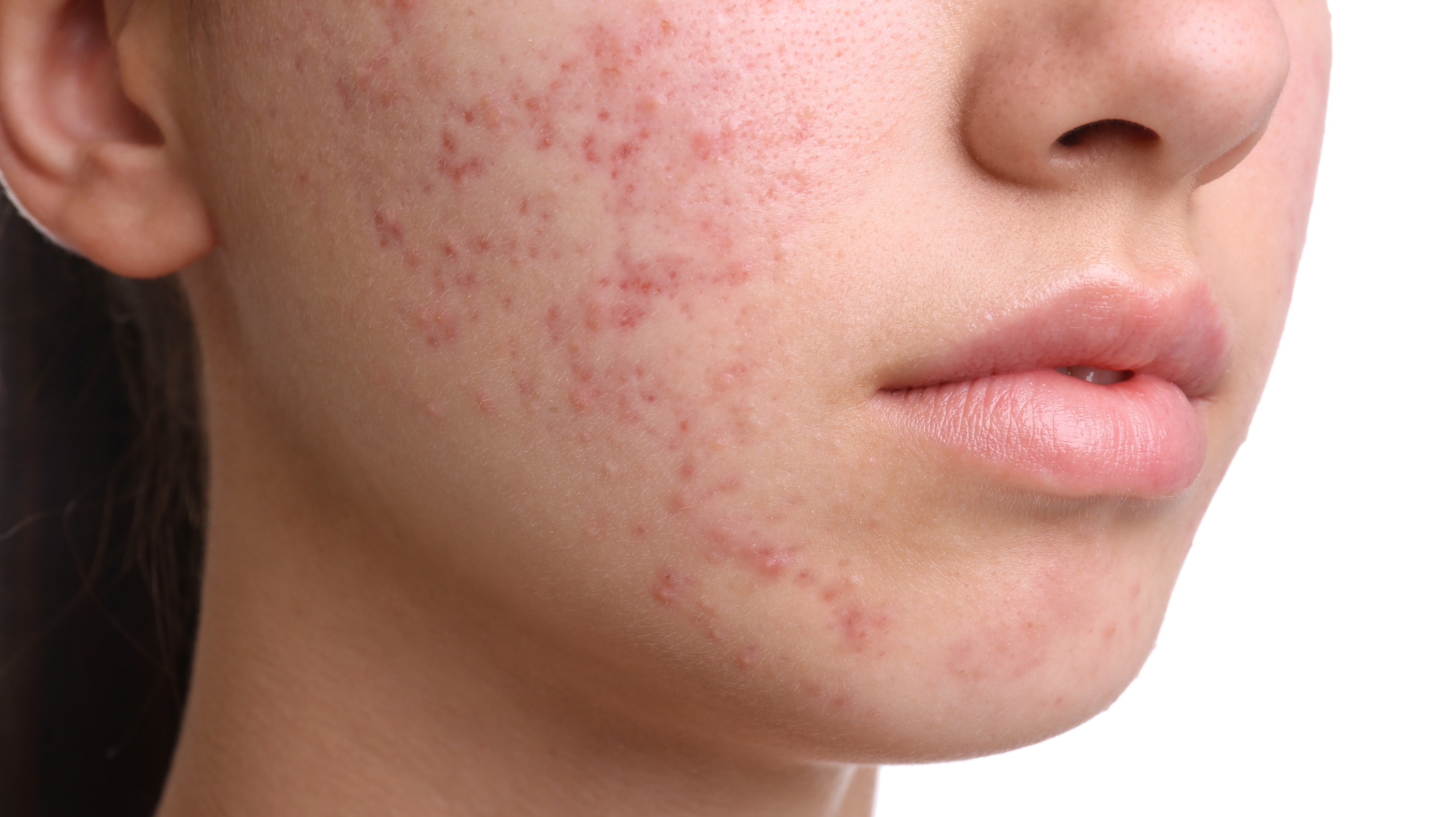 A woman’s face with acne - one of the more common perimenopause skin problems